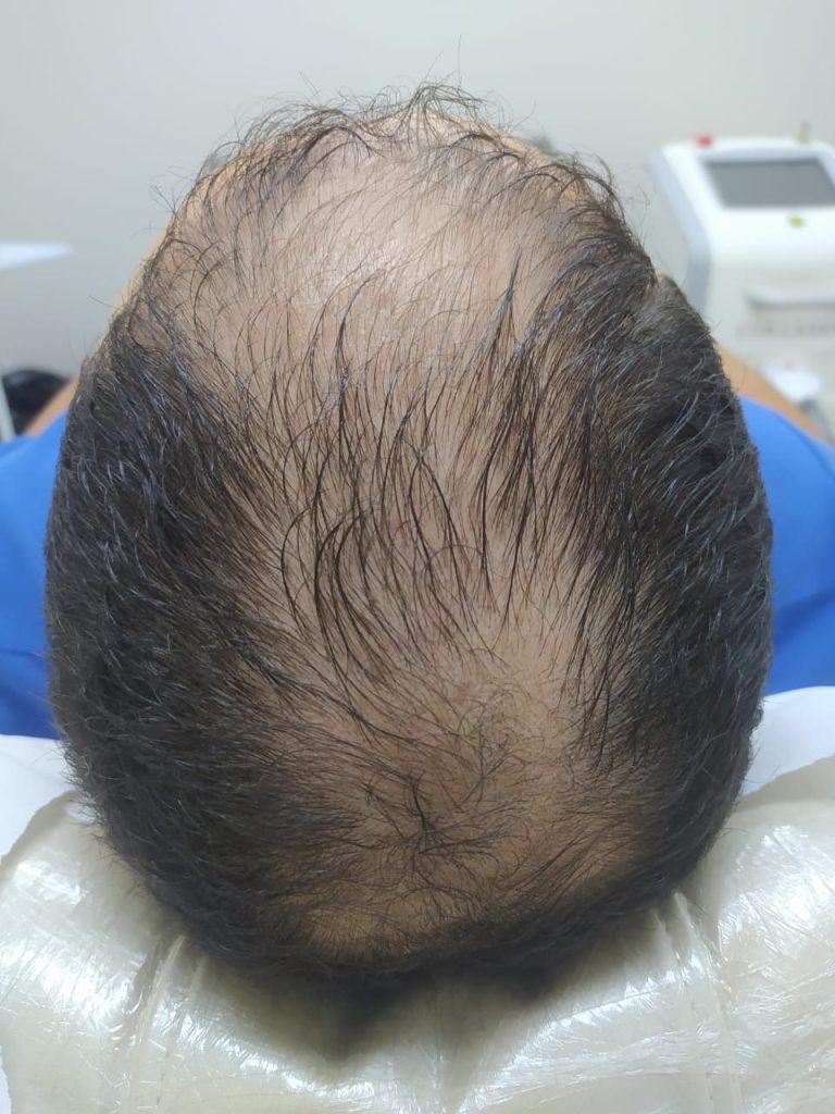 Terapia Capilar para Queda de Cabelo Evo+Clinic Indaiatuba