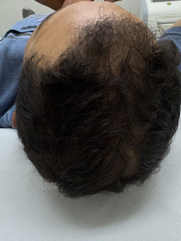 Terapia Capilar para Queda de Cabelo Evo+Clinic Indaiatuba