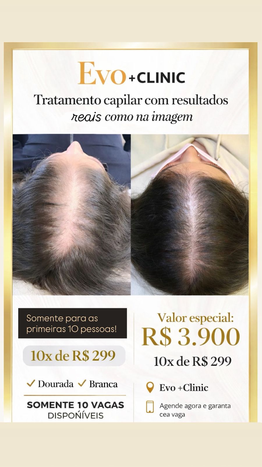 Evomaisclinic Indaiatuba Promoção Tratamento Capilar