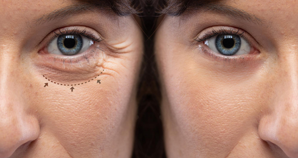 Preenchimento para Olheiras Indaiatuba